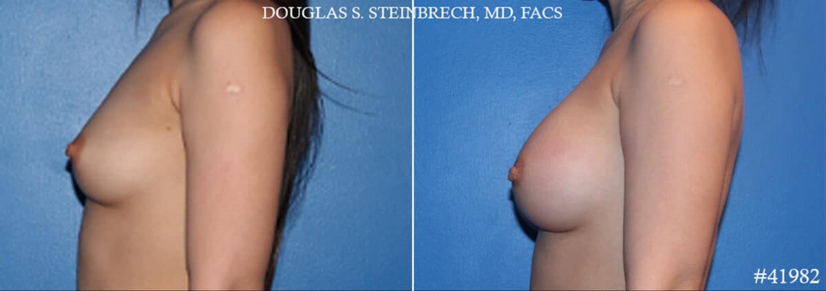 Breast Augmentation Before and After Photos in CA, Beverly Hills, Patient 19156