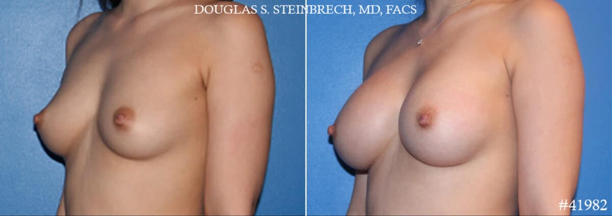 Breast Augmentation Before and After Photos in CA, Beverly Hills, Patient 19156