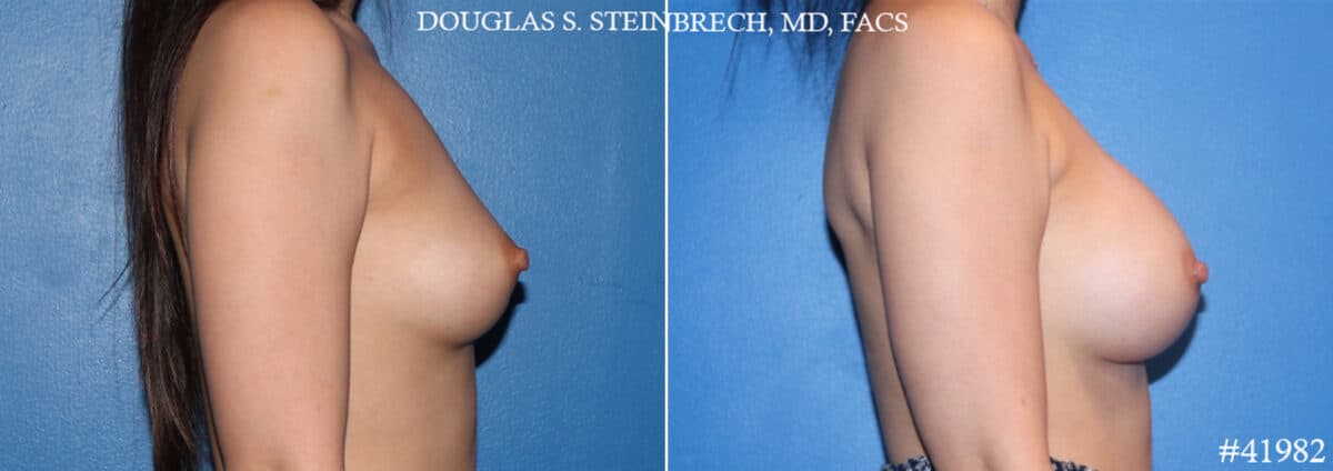 Breast Augmentation Before and After Photos in CA, Beverly Hills, Patient 19156