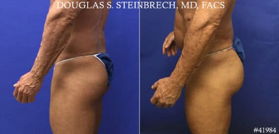 Gluteal Augmentation Before and After Photos in CA, Beverly Hills, Patient 19235