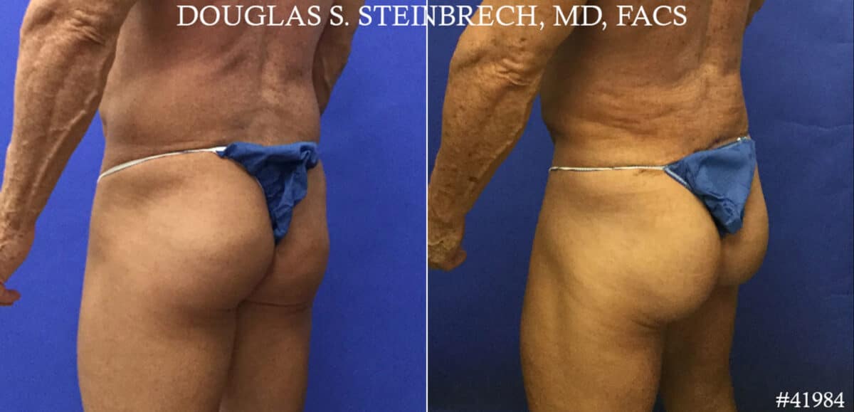 Gluteal Augmentation Before and After Photos in CA, Beverly Hills, Patient 19235