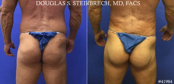 Gluteal Augmentation Before and After Photos in CA, Beverly Hills, Patient 19235