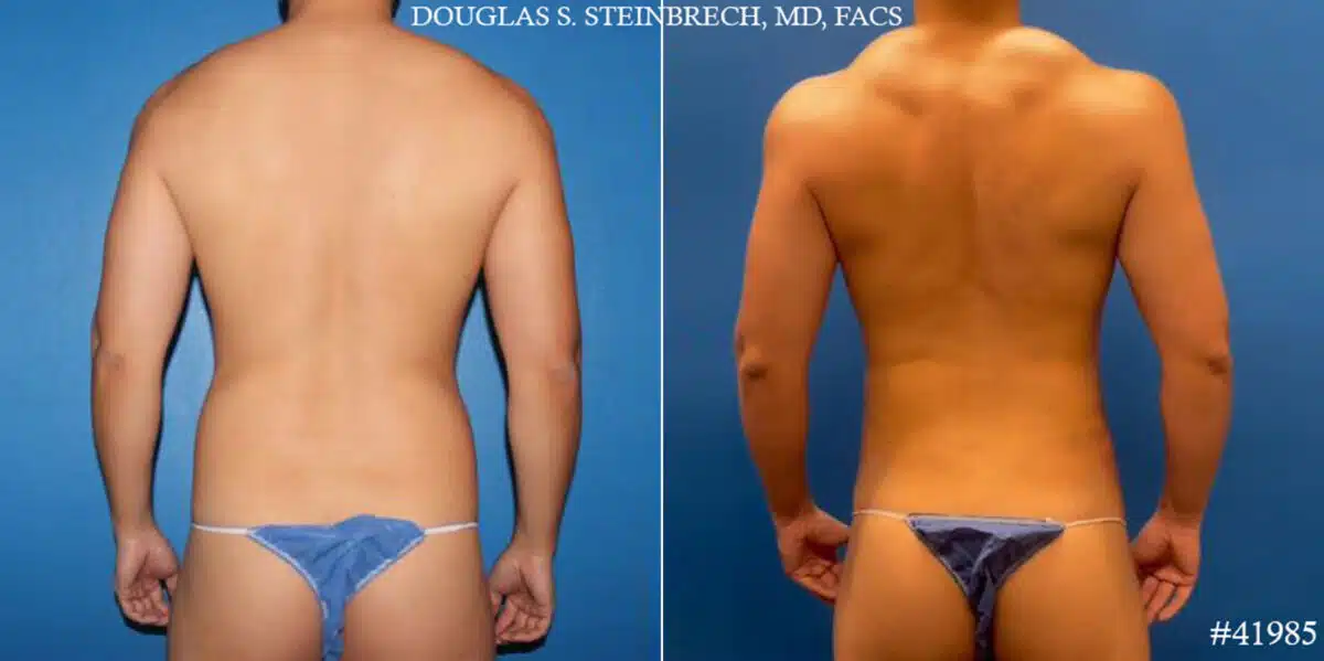 Body Banking Before and After Photos in CA, Beverly Hills, Patient 19245