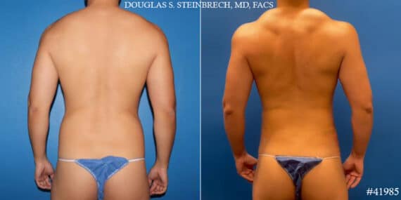 Body Banking Before and After Photos in CA, Beverly Hills, Patient 19245