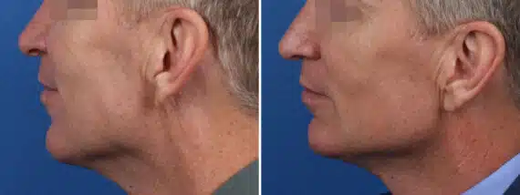 Chiseled Jawline Before and After Photos in New York, NY, Patient 15657