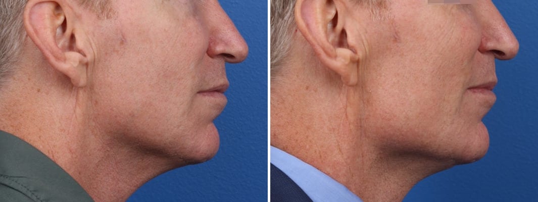 Chiseled Jawline Before and After Photos in New York, NY, Patient 15657