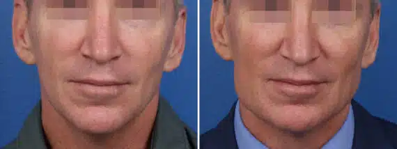 Chiseled Jawline Before and After Photos in New York, NY, Patient 15657