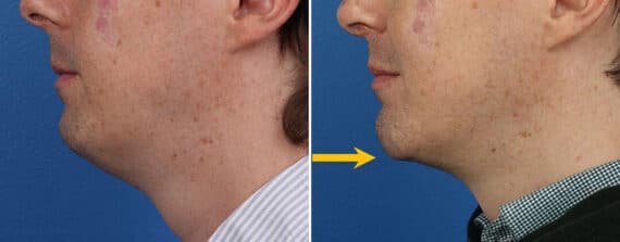 Chin Implant Before and After Photos in New York, NY, Patient 15696