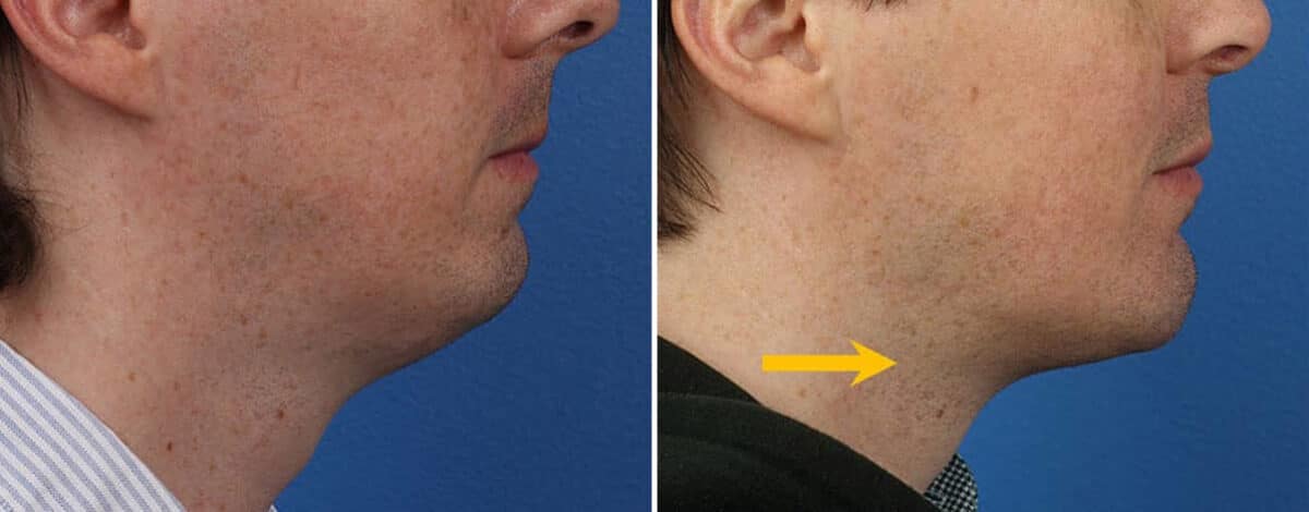 Chin Implant Before and After Photos in New York, NY, Patient 15696