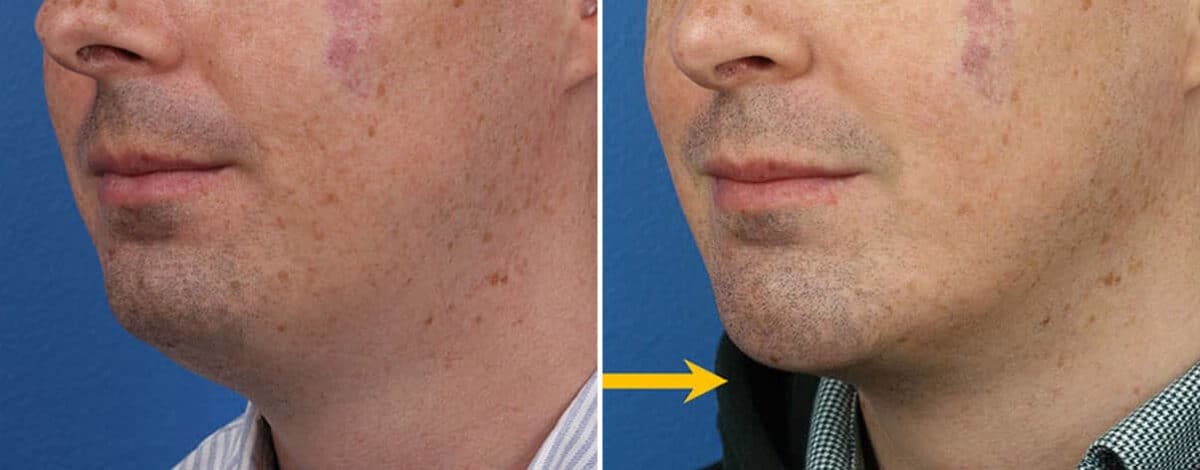 Chin Implant Before and After Photos in New York, NY, Patient 15696