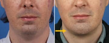 Chin Implant Before and After Photos in New York, NY, Patient 15696