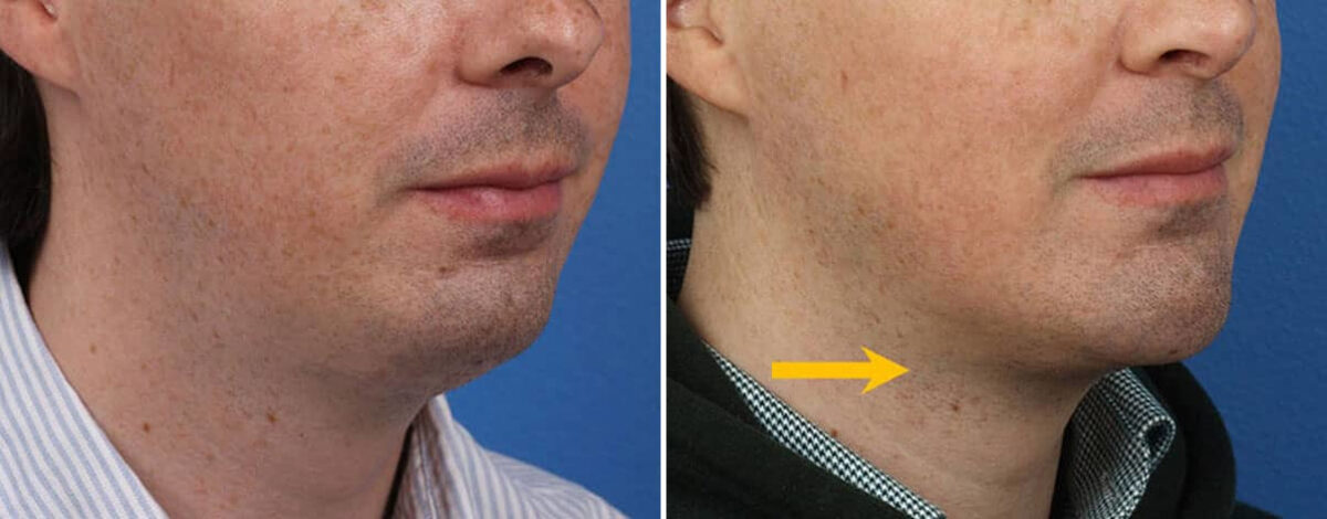 Chin Implant Before and After Photos in New York, NY, Patient 15696