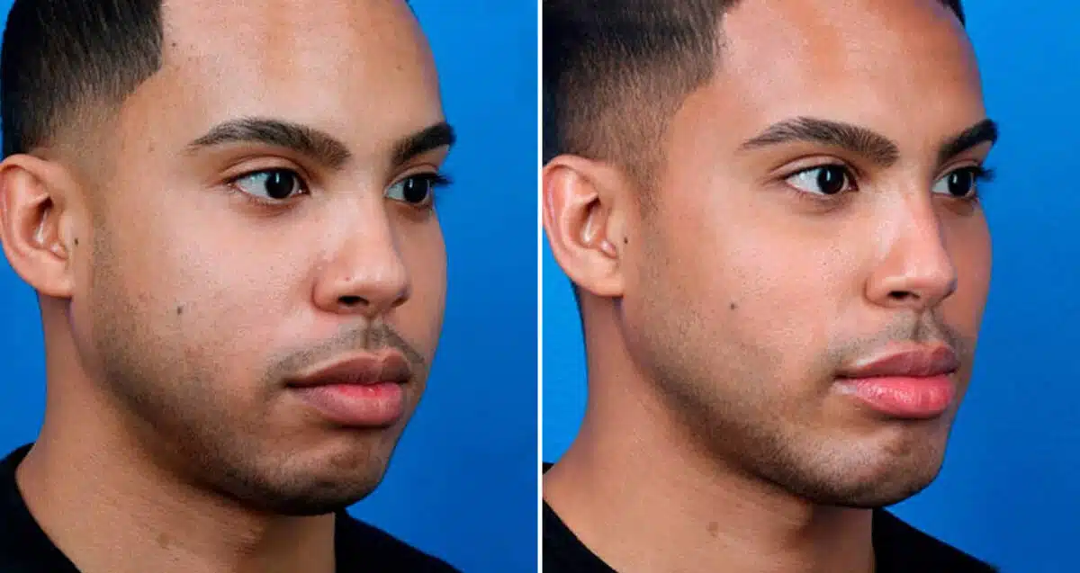 Chin Implant Before and After Photos in New York, NY, Patient 16905