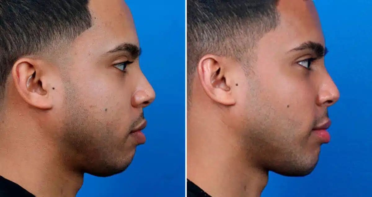 Chin Implant Before and After Photos in New York, NY, Patient 16905