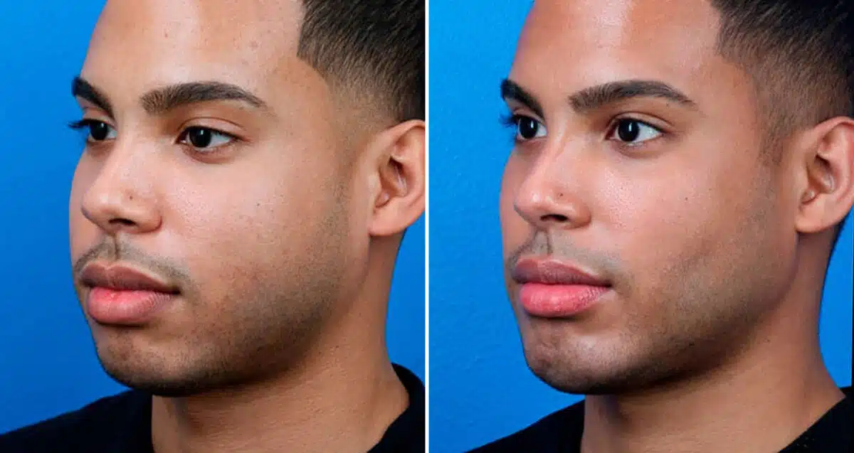 Male Model Make Over Before and After Photos in New York, NY, Patient 16905