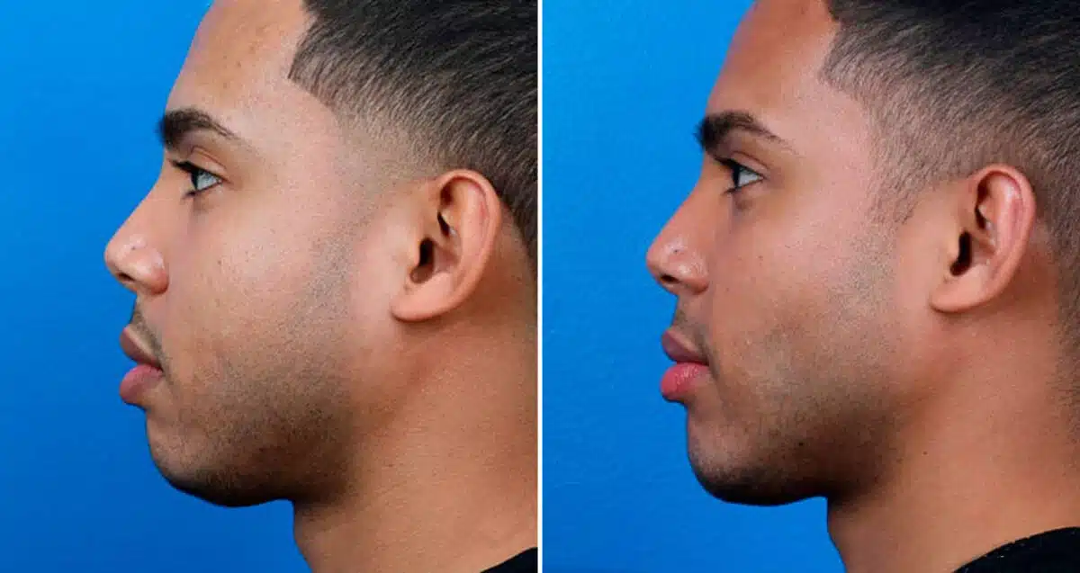 Chin Implant Before and After Photos in New York, NY, Patient 16905