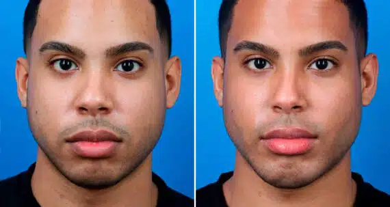 Male Model Make Over Before and After Photos in New York, NY, Patient 16905