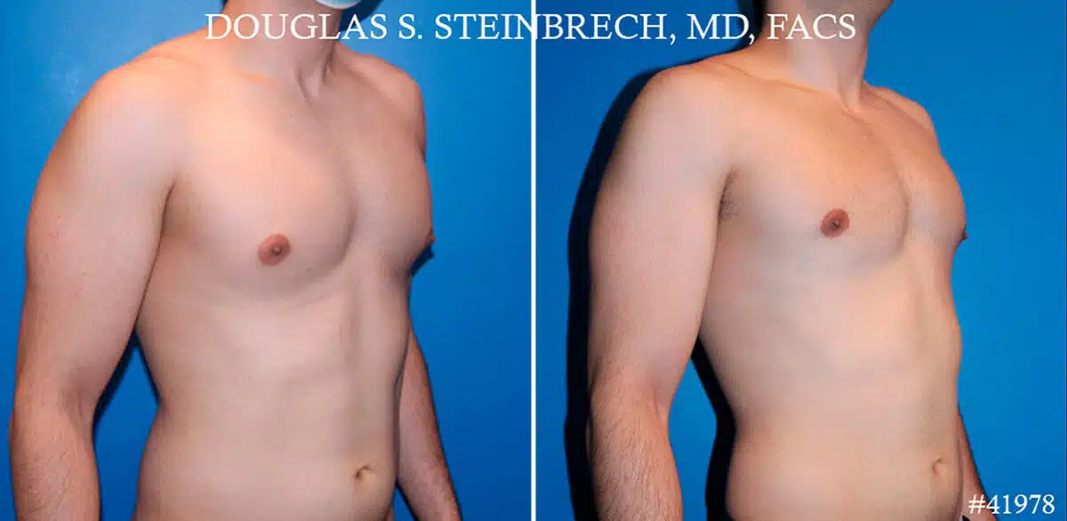 Gynecomastia Before and After Photos in CA, Beverly Hills, Patient 19130