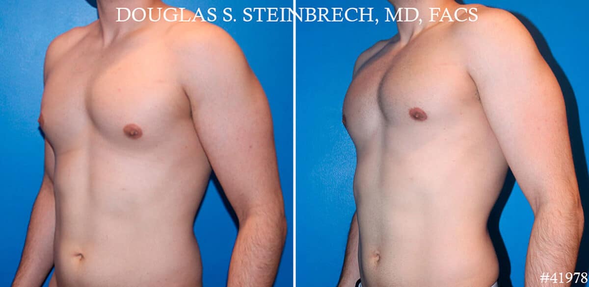 Gynecomastia Before and After Photos in CA, Beverly Hills, Patient 19130