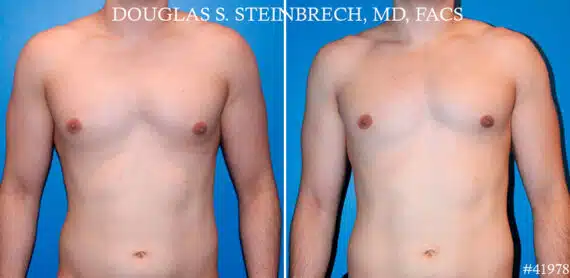 Gynecomastia Before and After Photos in CA, Beverly Hills, Patient 19130