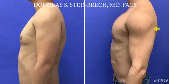 Biceps And Triceps Implants Before and After Photos in CA, Beverly Hills, Patient 19212