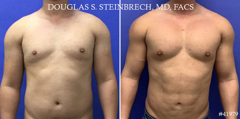Before and after male chest augmentation results beside text explaining pectoral implant placement.