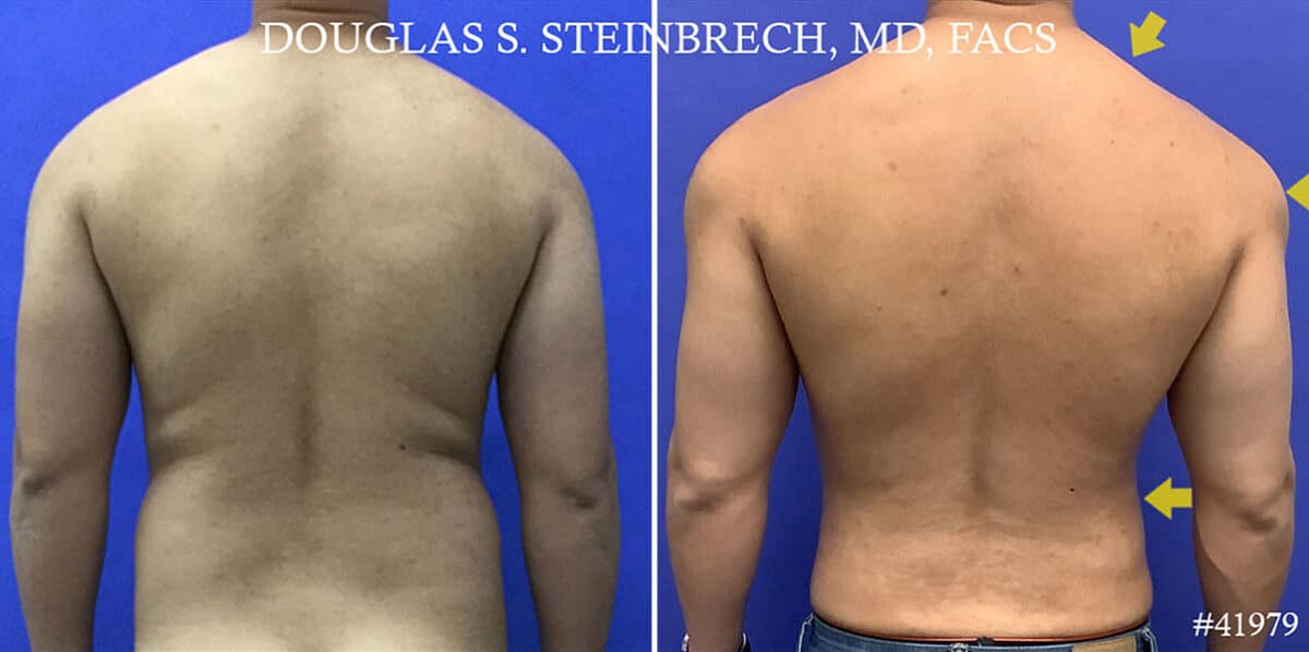 Biceps And Triceps Implants Before and After Photos in CA, Beverly Hills, Patient 19212