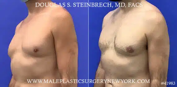 Liposuction Before and After Photos in CA, Beverly Hills, Patient 19546