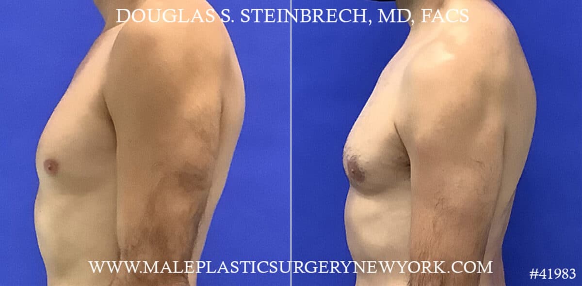 Body Banking Before and After Photos in CA, Beverly Hills, Patient 19546