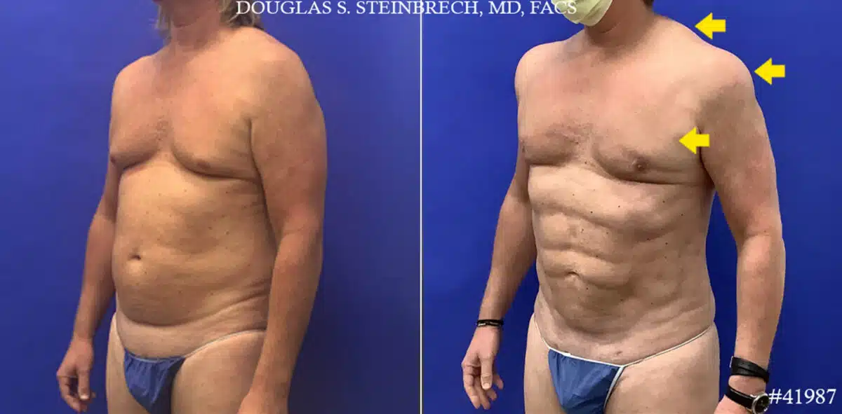 Body Banking Before and After Photos in CA, Beverly Hills, Patient 19556