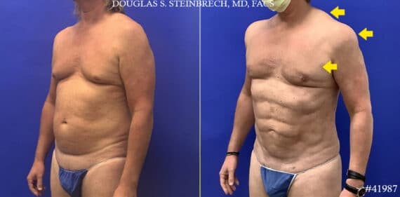 Body Banking Before and After Photos in CA, Beverly Hills, Patient 19556