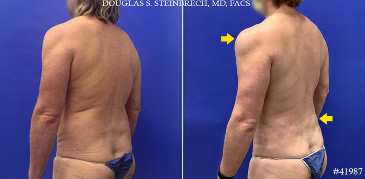 Body Banking Before and After Photos in CA, Beverly Hills, Patient 19556