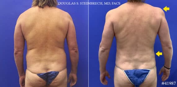 Body Banking Before and After Photos in CA, Beverly Hills, Patient 19556