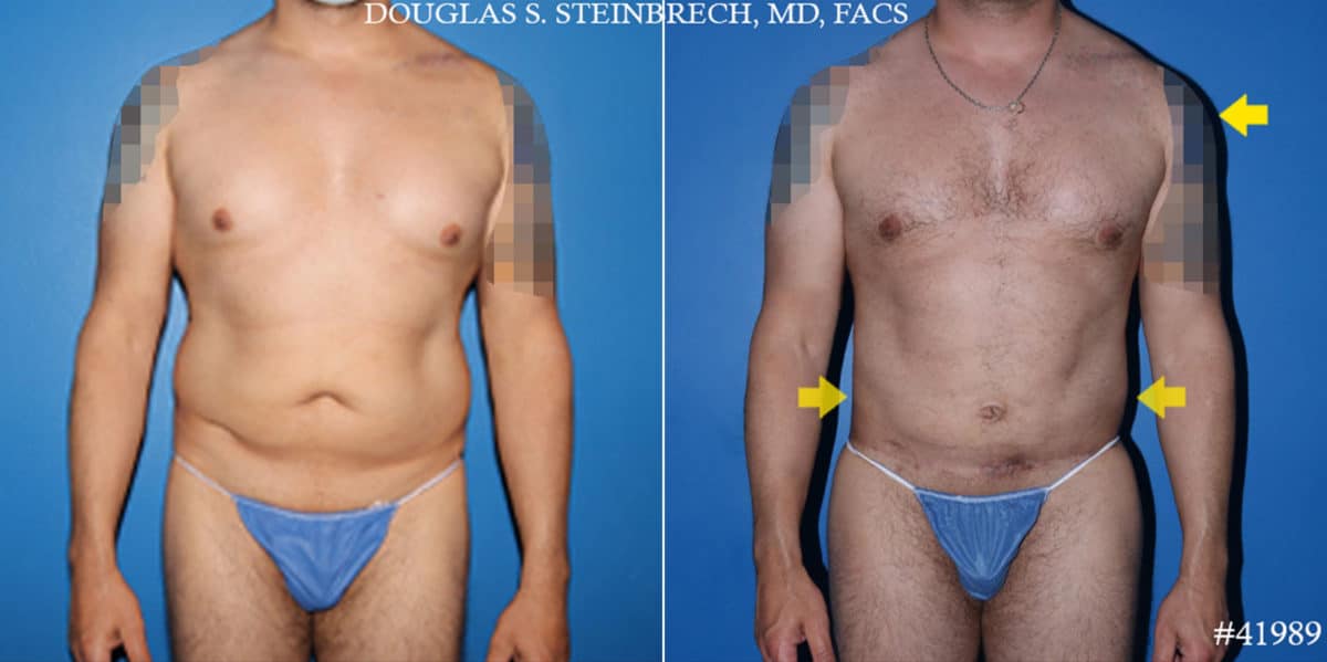 Body Banking Before and After Photos in CA, Beverly Hills, Patient 19574