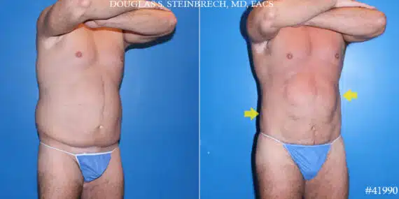 Body Banking Before and After Photos in CA, Beverly Hills, Patient 19578