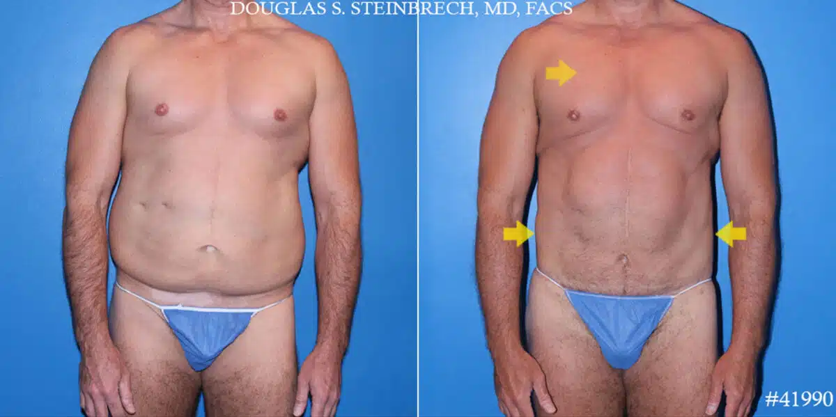 Body Banking Before and After Photos in CA, Beverly Hills, Patient 19578