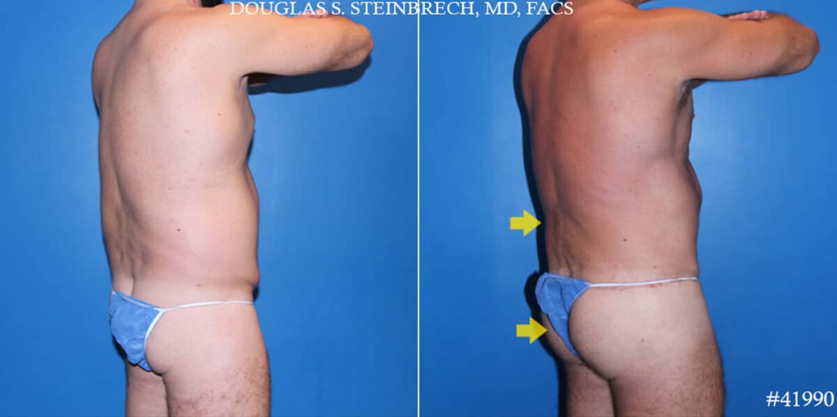 Body Banking Before and After Photos in CA, Beverly Hills, Patient 19578