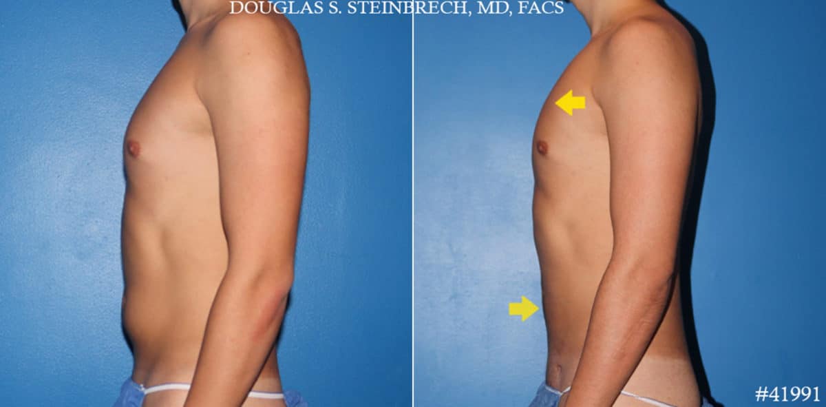 Body Banking Before and After Photos in CA, Beverly Hills, Patient 19588