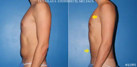 Liposuction Before and After Photos in CA, Beverly Hills, Patient 19588