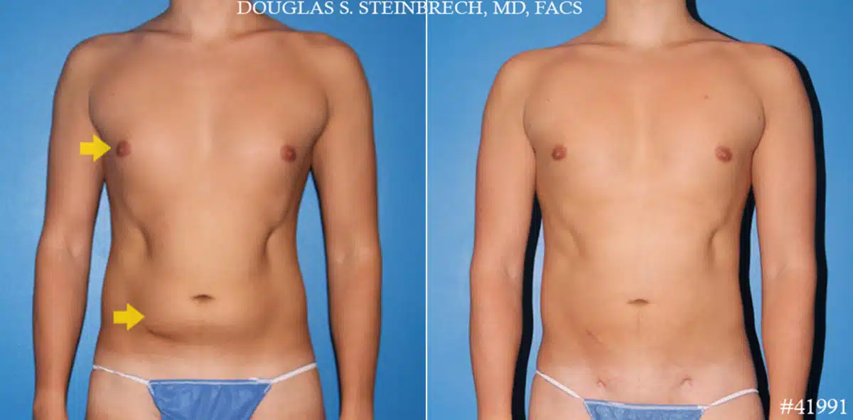 Body Banking Before and After Photos in CA, Beverly Hills, Patient 19588