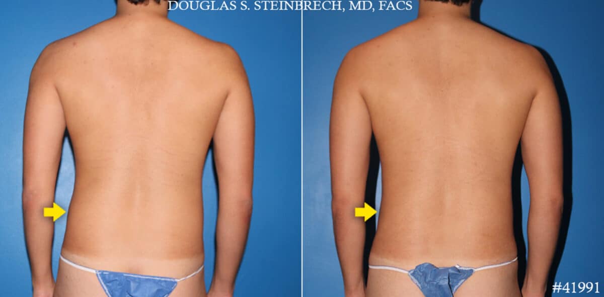 Body Banking Before and After Photos in CA, Beverly Hills, Patient 19588