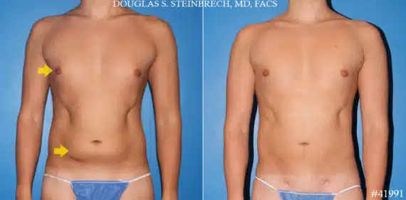 Liposuction Before and After Photos in CA, Beverly Hills, Patient 19588