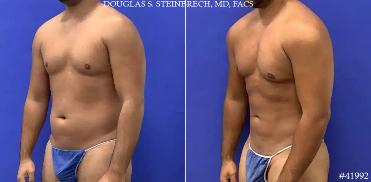 Body Banking Before and After Photos in CA, Beverly Hills, Patient 19598