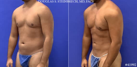 Liposuction Photos - Dr. Douglas Steinbrech