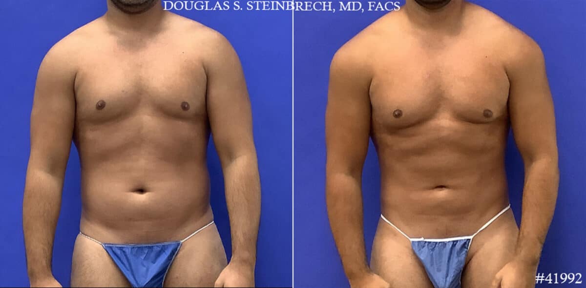 Body Banking Before and After Photos in CA, Beverly Hills, Patient 19598
