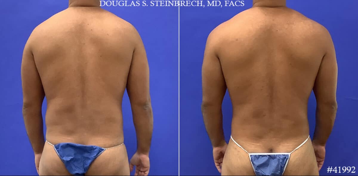 Body Banking Before and After Photos in CA, Beverly Hills, Patient 19598