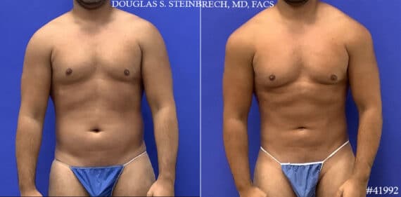 Body Banking Before and After Photos in CA, Beverly Hills, Patient 19598