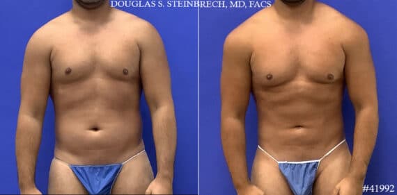 Liposuction Before and After Photos in CA, Beverly Hills, Patient 19598