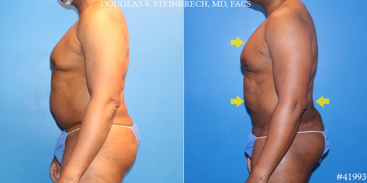 Body Banking Before and After Photos in CA, Beverly Hills, Patient 19608