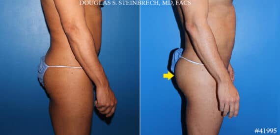 Gluteal Augmentation Before and After Photos in CA, Beverly Hills, Patient 19642